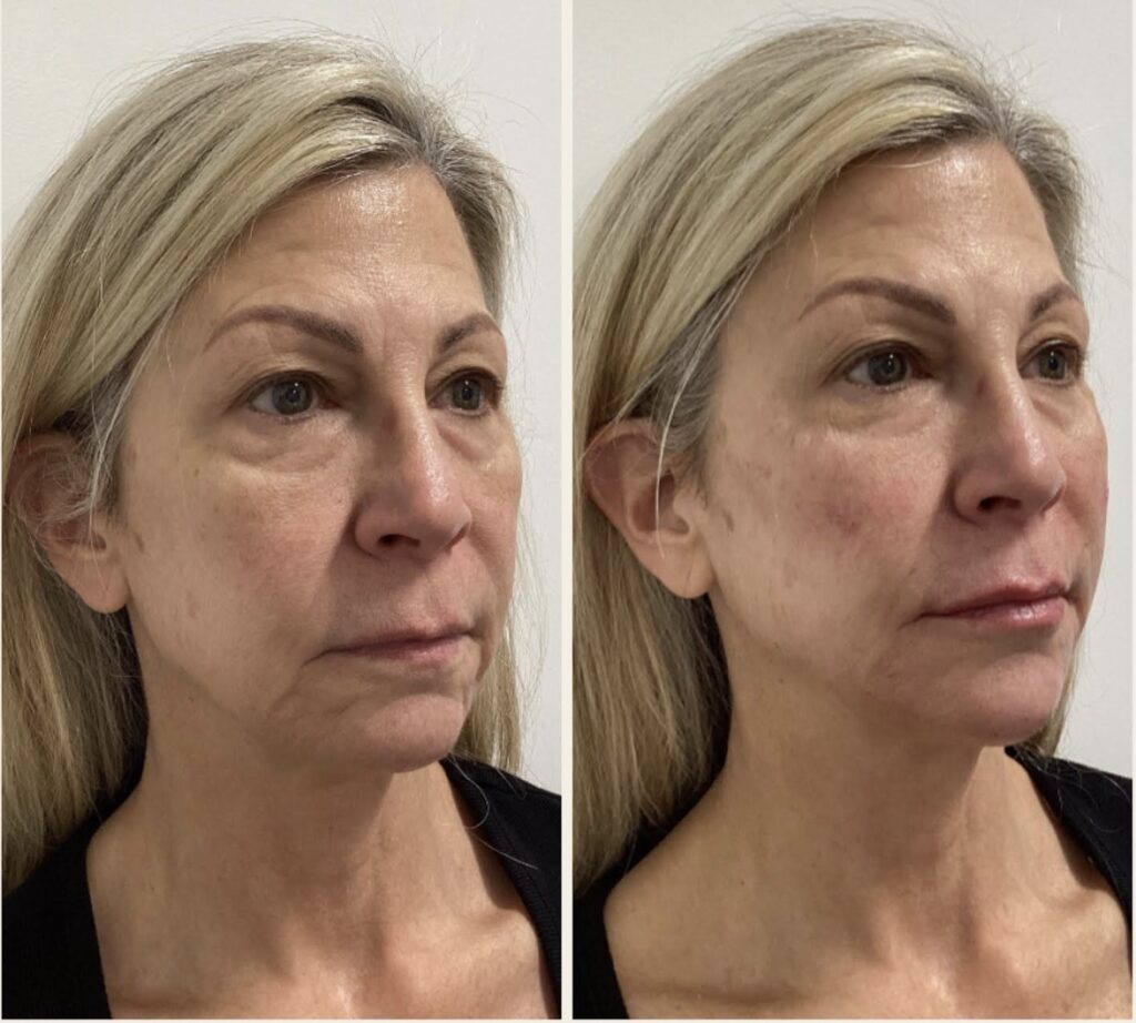 Before and after of a woman from a side profile option 3